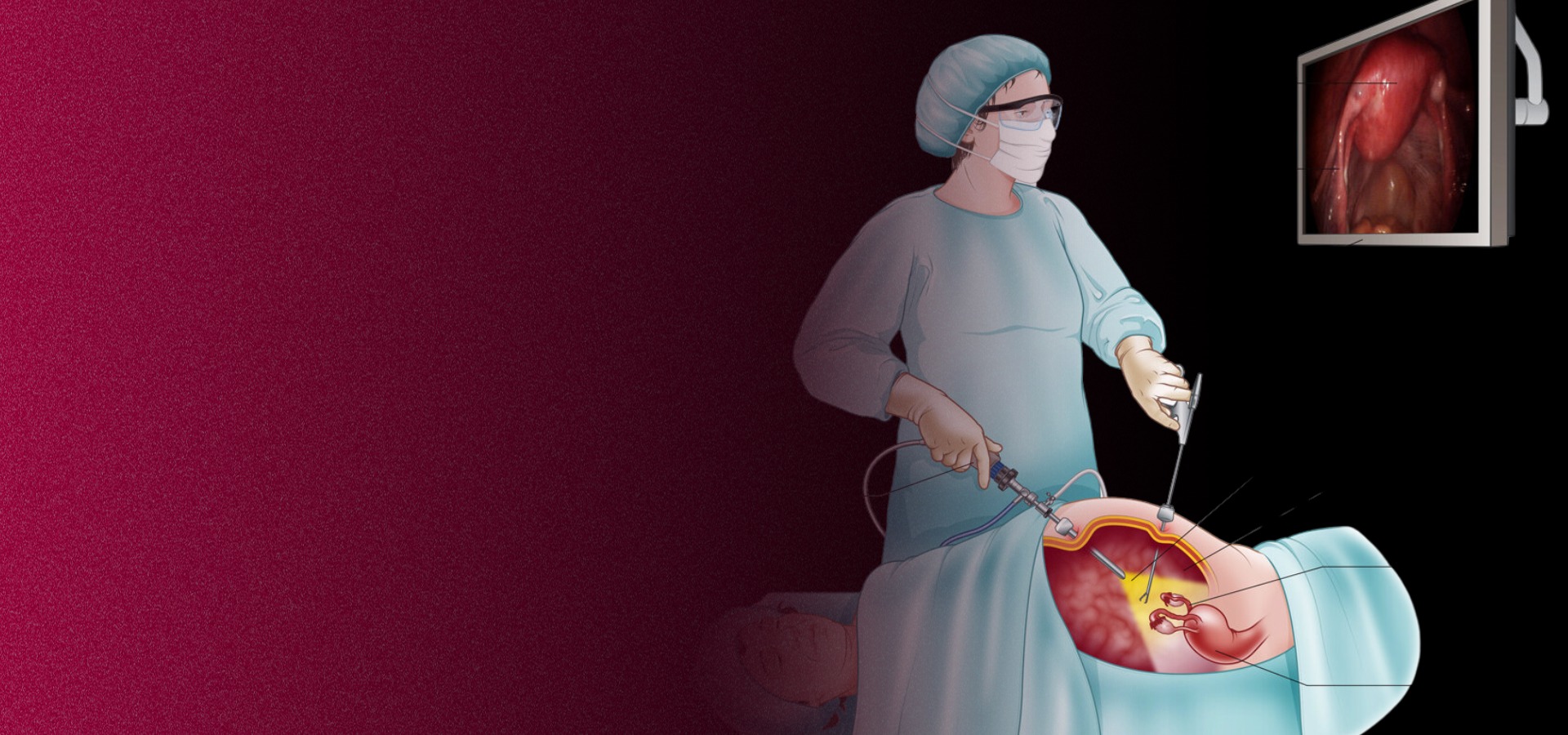 Laparoscopic surgery by Dr. Vishakha Munjal, laparoscopic surgeon in Delhi